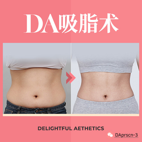韓國(guó)DA整形醫(yī)院的抽脂會(huì)根據(jù)體型設(shè)計(jì)手術(shù)方案