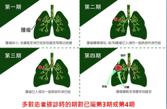 肺癌晚期治療現(xiàn)新突破 免疫治療+標靶藥+化療助延存活期