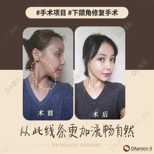 在韓國DA整形醫(yī)院做最后一次下頜角修復(fù)手術(shù)