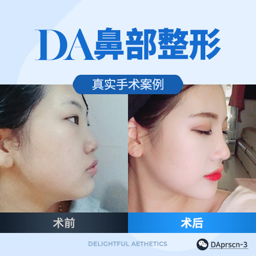 韓國DA整形醫(yī)院鼻部整形到底有多少種方法