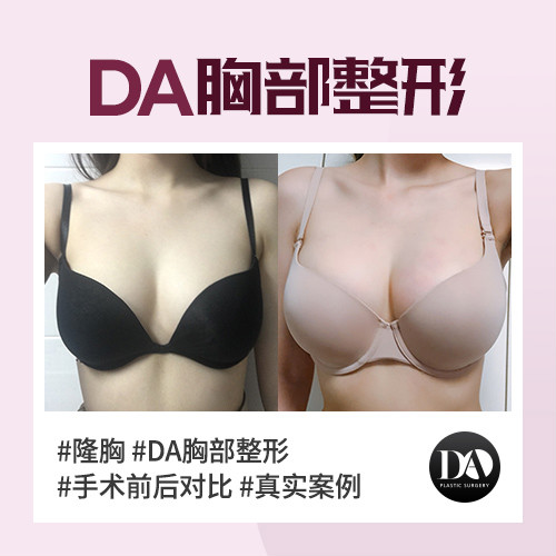韓國(guó)DA整形醫(yī)院:胸部整形的趨勢(shì)從大變?yōu)檐洠? onmousewheel=
