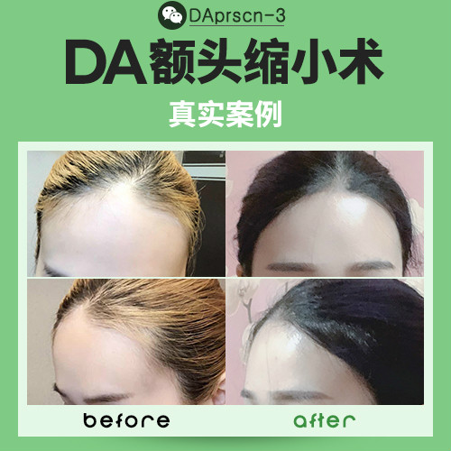 韓國DA整形醫(yī)院告訴你額頭縮小術(shù)的優(yōu)勢