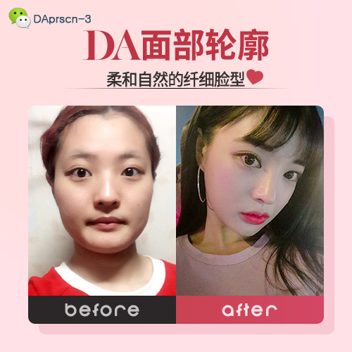 面部輪廓比大小更重要的是柔美的自然線條