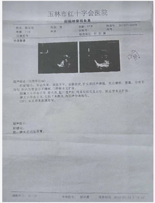 治療肝硬化肝腹水專家邱延存