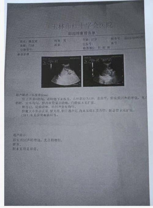 治療肝硬化肝腹水專家邱延存