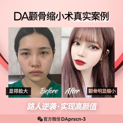 【韓國(guó)DA顴骨縮小】截骨越多并不代表更美麗