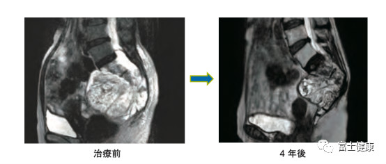 重離子之父談重離子線治療的特征和優(yōu)點
