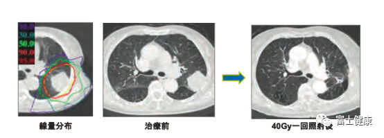 重離子之父談重離子線治療的特征和優(yōu)點