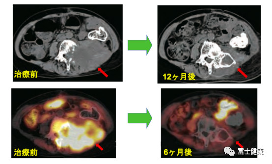 重離子之父談重離子線治療的特征和優(yōu)點